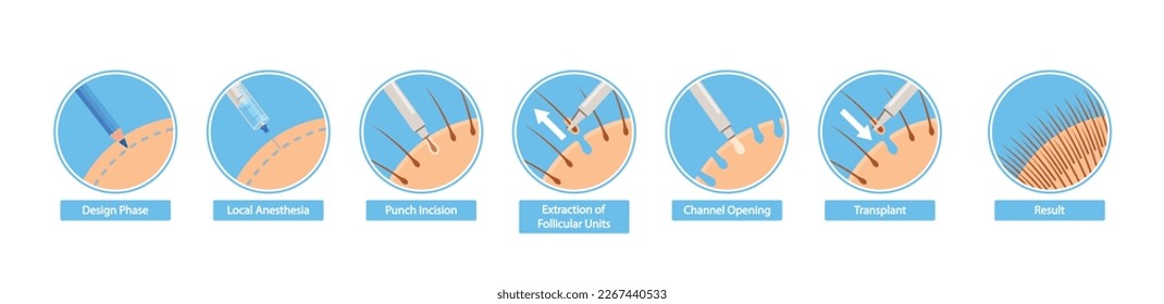 Procedimiento De Trasplante De Pelo En Etapas Infográficas En Curso. Fase de diseño, Anestesia local, Incisión de punzonado, Extracción de unidades foliculares, Apertura del canal y Resultado. Ilustración del vector de dibujos animados