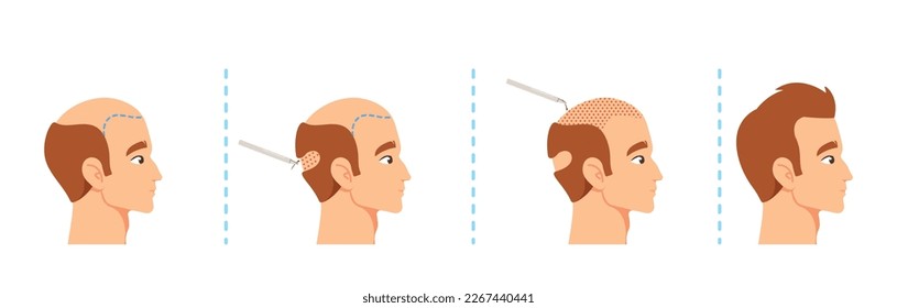 Hair Transplantation Procedure Stages, Male Scalp Before And After. Visual Aids For Medical Presentations Or Educational Materials Related To Hair Restoration. Cartoon People Vector Illustration