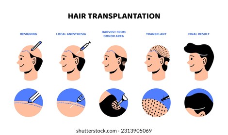 Infografía del proceso de trasplante de pelo. Tratamientos médicos de belleza. Lucha contra la alopecia. Diseño, anestesia, cosecha de área donante y trasplante. Dibujo vectorial plano de dibujos animados