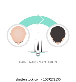 Hair transplantation surgery 2 steps infographics. Patient before and after the procedure. Male hair loss treatment with FUT, FUE method. Alopecia medical design for clinics and diagnostic centers.