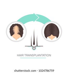 Hair transplantation surgery 2 steps infographics. Patient before and after the procedure. Female hair loss treatment with FUT, FUE method. Women alopecia medical design. Vector illustration.