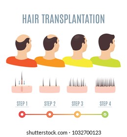 Hair transplantation surgery steps infographics. Man patient before and after procedure. Male hair loss treatment with FUT, FUE method. Alopecia medical design for clinics and diagnostic centers.