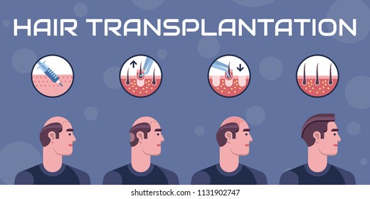 Hair transplantation surgery steps infographics. Patient before and after the procedure. Male hair loss treatment with FUT, FUE method. Alopecia medical design for clinics and diagnostic centers.