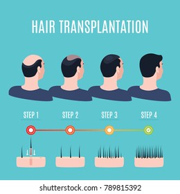 Hair transplantation surgery steps infographics. Patient before and after the procedure. Male hair loss treatment with FUT, FUE method. Alopecia medical design for clinics and diagnostic centers.