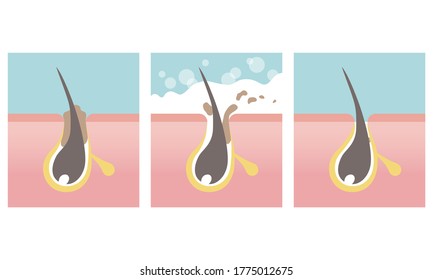 Haired pore cleansing, facial skin care image. Washing skin with soap. Vector illustration in flat cartoon style.