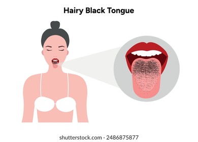 Hairy black tongue, medical information