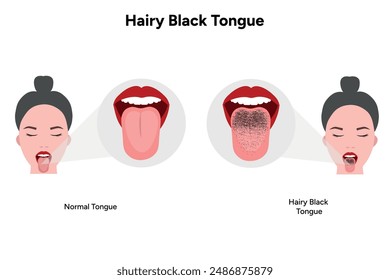 Hairy black tongue, medical information