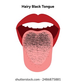 Hairy black tongue, medical information