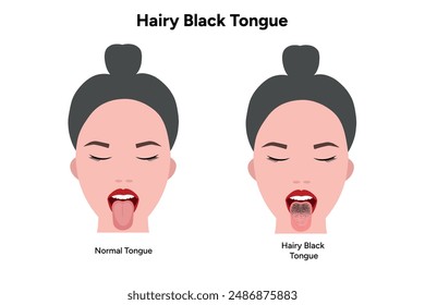 Hairy black tongue, medical information