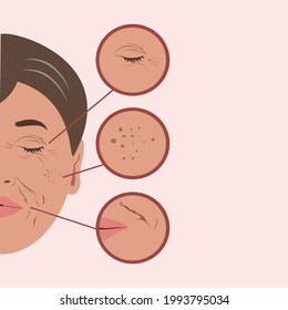 Half of aged woman face skin, focus on cheek  groove, Smile lines ,wrinkles, acne, wizened.  Vector isolate flat design concept for Beauty, skincare, Acne treatment ,makeup or anti-aging banner or web