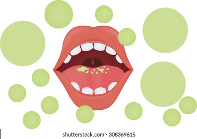 Halitosis Bad Breath