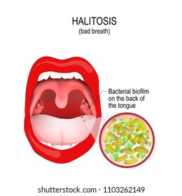 halitosis. Bad breath. bacterial biofilm on the back of the tongue, and bacteria (close-up). Human mouth. Vector diagram for medical and educational use