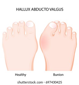 hallux abducto valgus is a deformity of the joint connecting the big toe to the foot. healthy joint  and bunion. Comparison