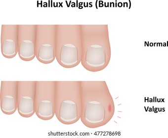 Hallux Valgus