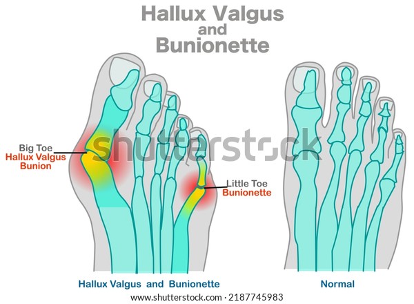 Hallux valgus,\
bunionette  anatomy. Foot bones, joint deformity feet. Top foot x\
ray, angle of  little pinky, big toe structure. Orthopedic patients\
surgery. Illustration\
vector