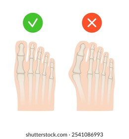 Hallux valgus. Valgus deformity of the big toe joint. Vector illustration.