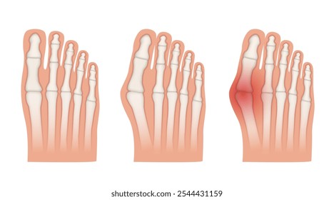 Hallux valgus. Valgus deformity of the big toe joint. Vector illustration.