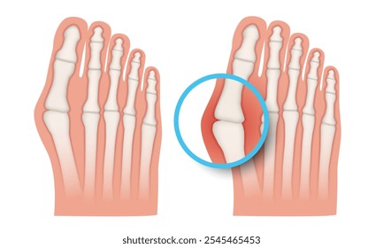 Hallux valgus. Valgus deformity of the big toe joint. Vector illustration.