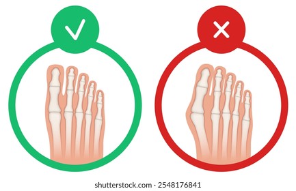 Hallux valgus. Valgus deformity of the big toe joint. Vector illustration.