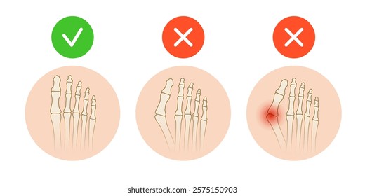 Hallux valgus. Valgus deformity of the big toe joint. Vector illustration.