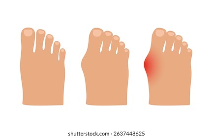Hallux valgus. Valgus deformity of the big toe joint. Vector illustration.