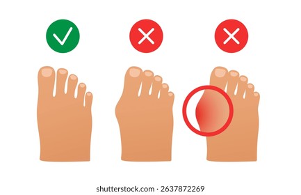 Hallux valgus. Valgus deformity of the big toe joint. Vector illustration.