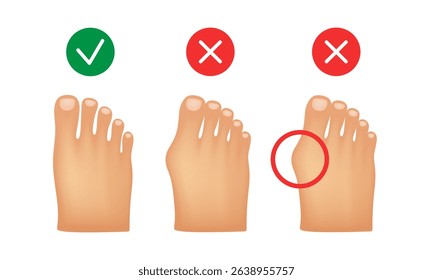 Hallux valgus. Valgus deformity of the big toe joint. Vector illustration.