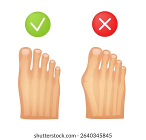 Hallux valgus. Valgus deformity of the big toe joint. Vector 3d illustration.