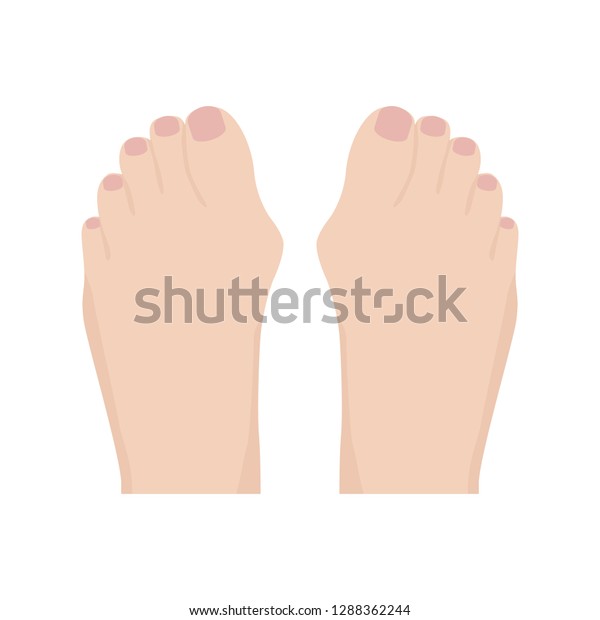 Hallux Valgus Deformity Bunion Bone Toe Stock Vector Royalty Free