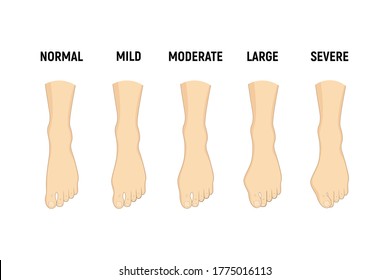 Hallux valgus disease stages, normal, mild, moderate, large, severe Vector illustration Orthopedics foot illness