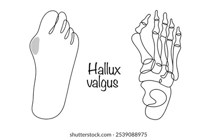 Hallux valgus. Foot deformity in which changes occur in the first metatarsophalangeal joint, causing the first toe to deviate outward. Hand drawn hallux valgus deformity. Vector illustration.