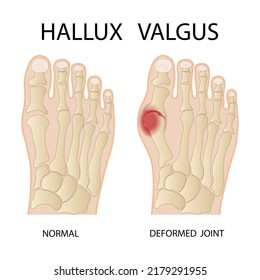 Hallux Valgus Medical Infographic Vector Illustration Stock Vector ...