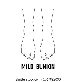 Hallux valgus, mild bunion. Vector illustration. Orthopedics foot illness