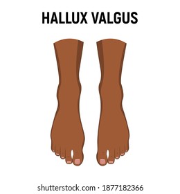 Hallux valgus problem. Vector illustration. Orthopedics bunion health