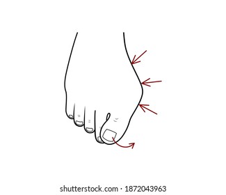 Hallux valgus surgery correction. Vector illustration. Orthopedics health