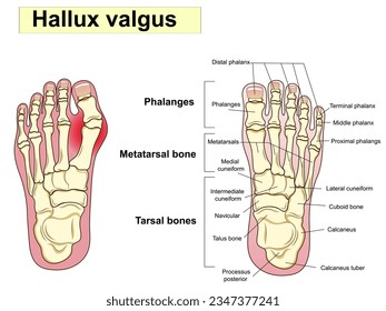 Hallux valgus text. Anatomy. Human foot bones. Signatures, also for clinics