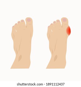 Hallux valgus del pulgar después de lesión u otros factores