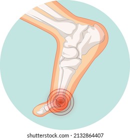 Hallux valgus types in circle template illustration