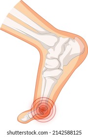 Hallux valgus types on white background illustration