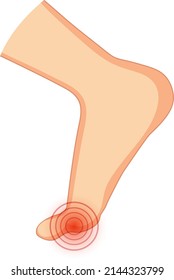 Hallux valgus types on white background illustration