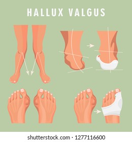 Hallux valgus vector medicine poster. Colorful design. Detailed image with text.