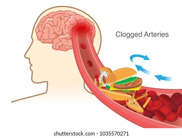 Hamburger And Pizza And French Fries Block Red Blood Cell Cause Clogged In Artery Before Into Brain. Illustration About Stoke Disease.