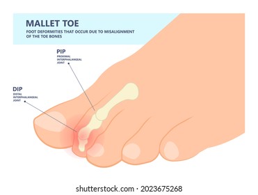 Hammer toe claw morton's hallux valgus curly turf bent joint flexible foot deformities shoes corns feet high heels curls bone spur distal lesser injury Trauma bend arch pes cavus flexion PIP DIP big