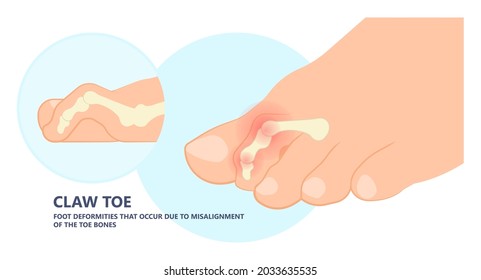 Hammer toe claw morton's hallux valgus curly turf bent joint flexible foot deformities shoes corns feet high heels curls bone spur distal lesser injury Trauma bend arch pes cavus flexion PIP DIP big