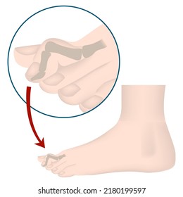 Hammer toe deformity. Medical poster. Vector illustration