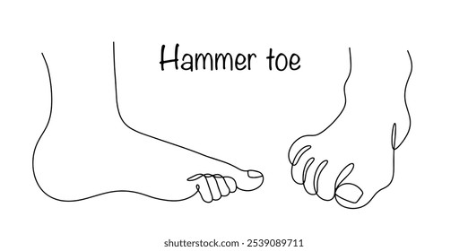 Hammer toe. Pathological changes expressed in the curvature of the fingers, in which the phalanges take a bent position, resembling a hammer. Line drawn medical vector.