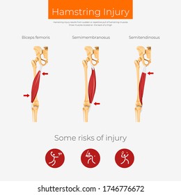 Hamstring Injury Anatomy Scheme Poster