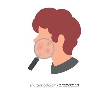 Han Drawn Acne Nodule in Face Skin
