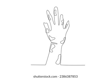 Eine von Lepra betroffene Hand. Einzeilige Zeichnung am Weltleprosenzag