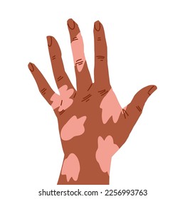 Mano de la palma en gesto relajado, piel marrón con parche de vitiligo
